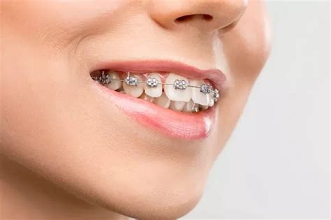 brackets metalicos autoligables|brackets autoligables beneficios.